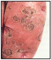 Picture 60 - Tabacco Rattle Virus – external symptom. Description follows.